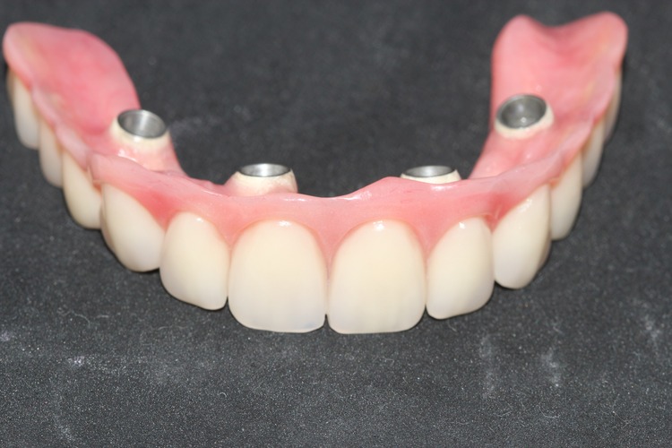 Prótese Sobre Implantes 1