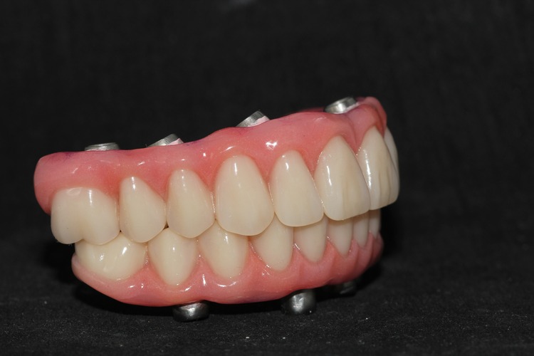 Prótese Sobre Implantes 3