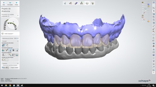 Lente de Contato Dental 1