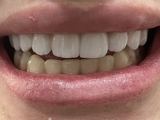 Lente de Contato Dental 2