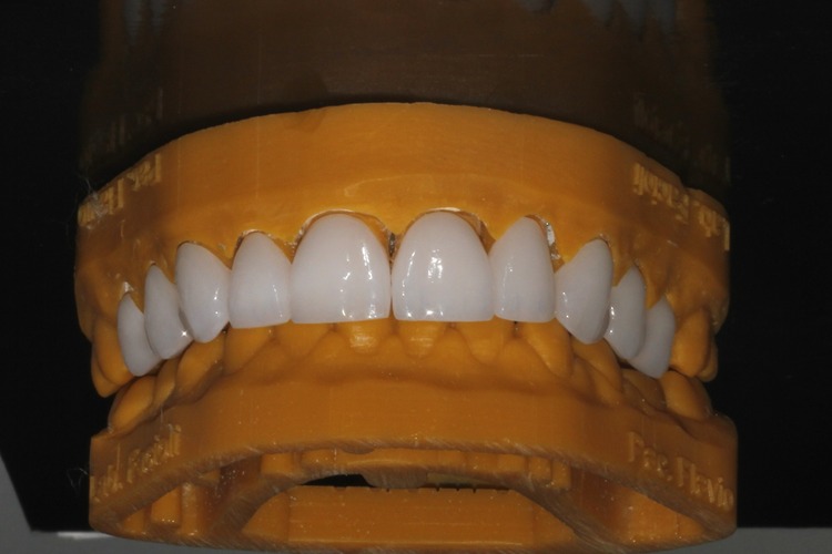 Lente de Contato Dental 3