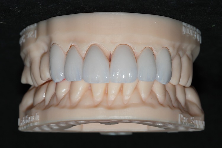 Lente de Contato Dental 4