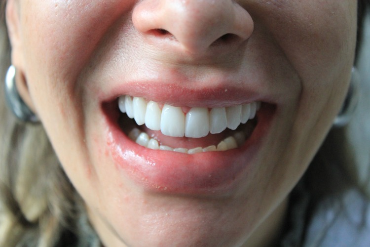 Lente de Contato Dental 5