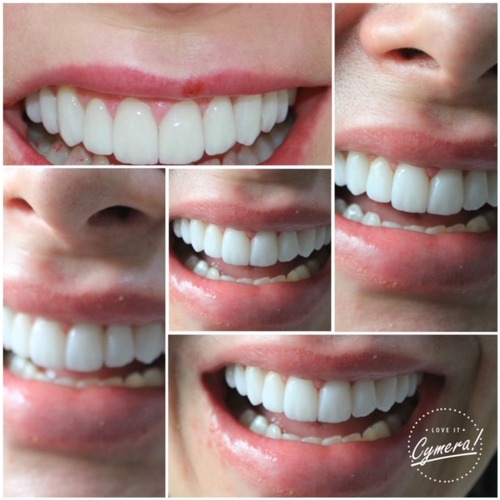 Lente de Contato Dental 6