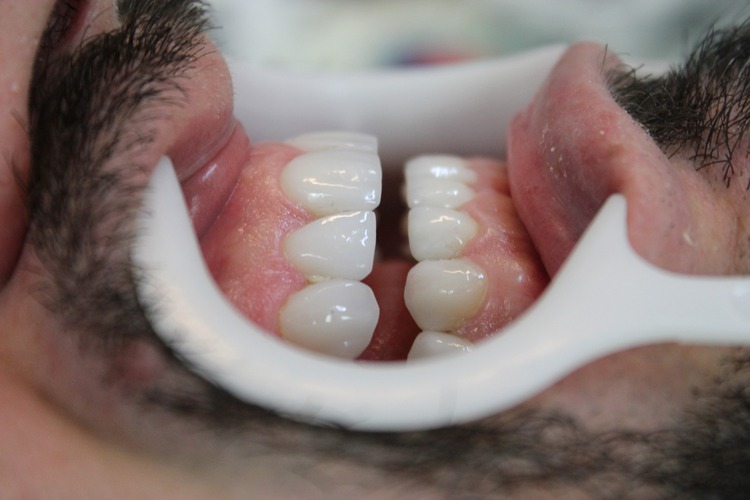Lente de Contato Dental 7