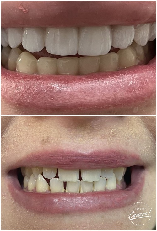 Lente de Contato Dental 8