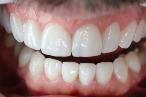Lente de Contato Dental 9